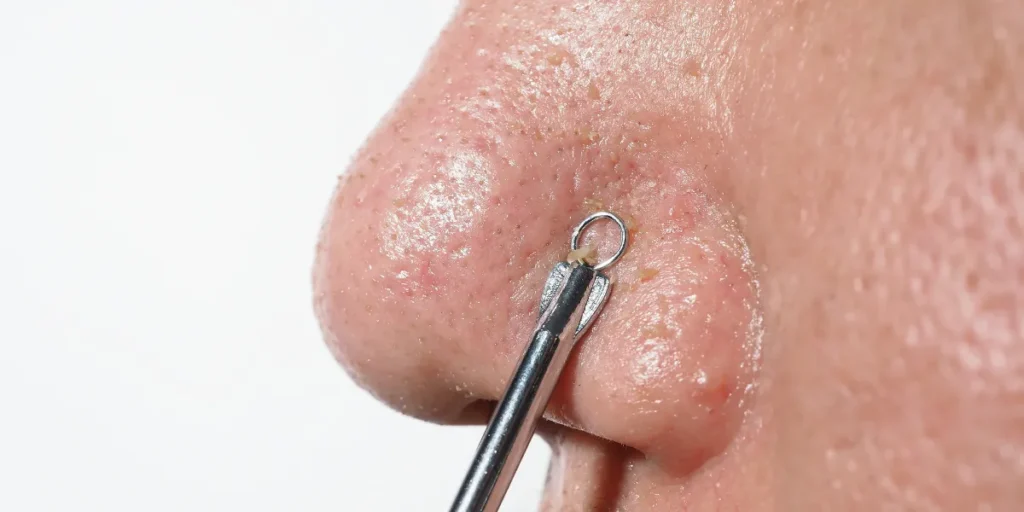 nose skin is peeling