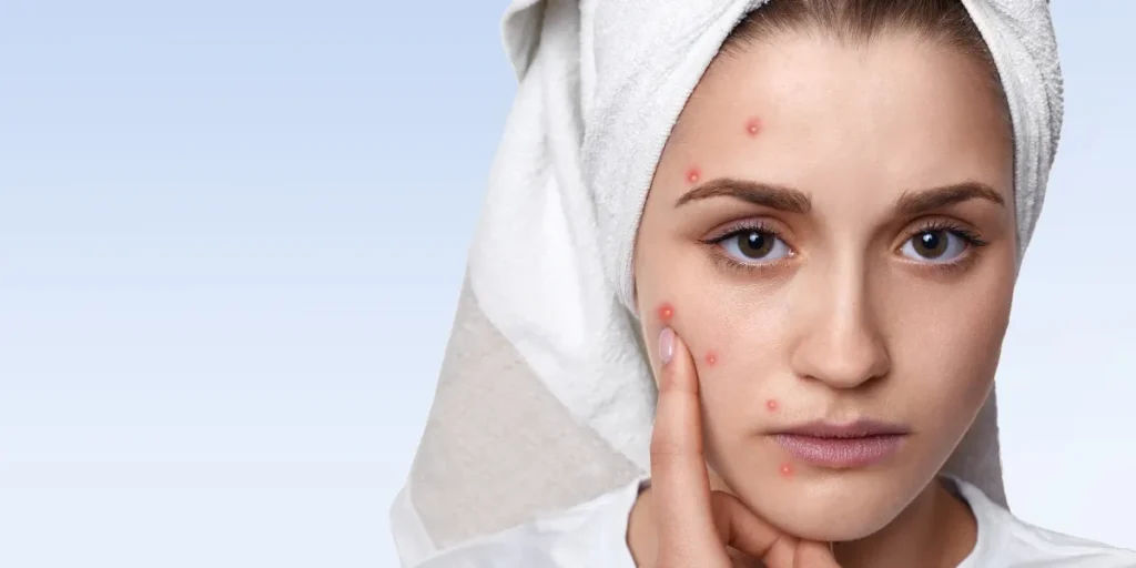 blackheads that are deep